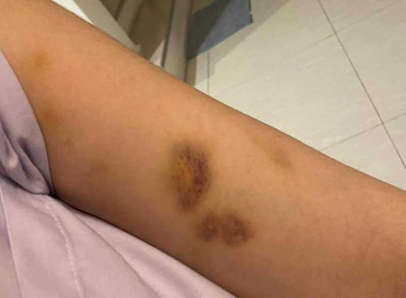 ไฮโซสาวถูกอดีตสามีลูกชายดีเจดังทำร้าย ไฮโซสาวถูกอดีตสามีลูกชายดีเจดังทำร้าย