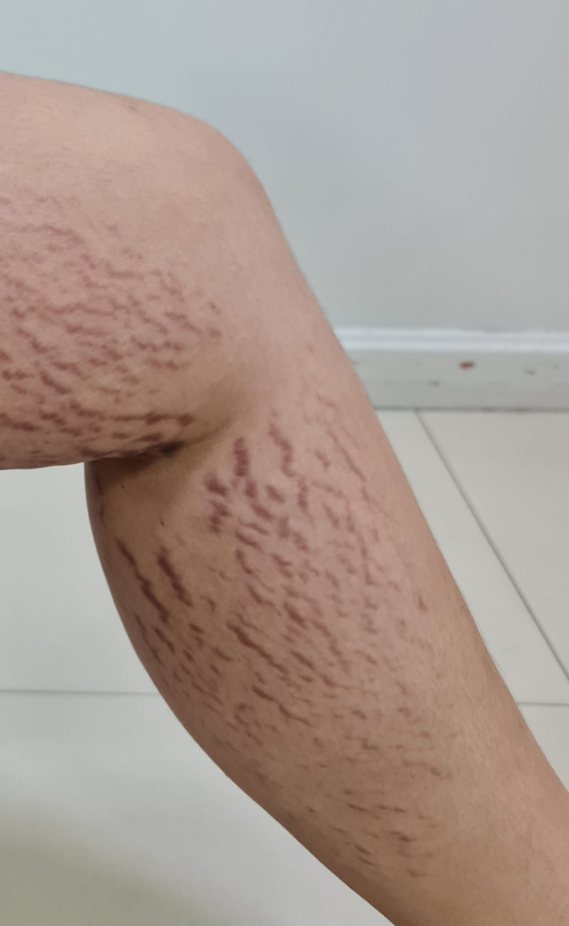 เปิดสภาพผิวหลังทาครีมขาวผสมสเตียรอยด์ เปิดสภาพผิวหลังทาครีมขาวผสมสเตียรอยด์