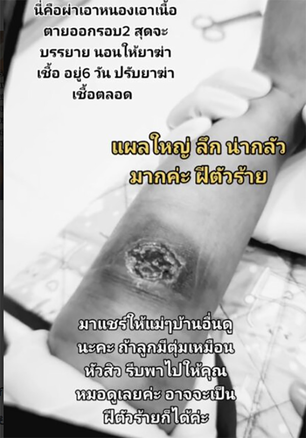 ลูกตุ่มแดงขึ้นนึกว่าแมลงกัด ก่อนทรุดส่งโรงพยาบาล ลูกตุ่มแดงขึ้นนึกว่าแมลงกัด ก่อนทรุดส่งโรงพยาบาล