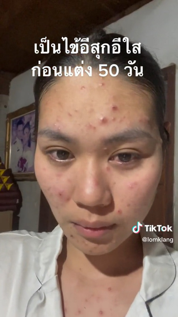 เจ้าสาวเป็นอีสุกอีใสก่อนแต่งงาน รอยแผลเป็นยับ เจอช่างแต่งหน้าเทพ เจ้าสาวเป็นอีสุกอีใสก่อนแต่งงาน รอยแผลเป็นยับ เจอช่างแต่งหน้าเทพ