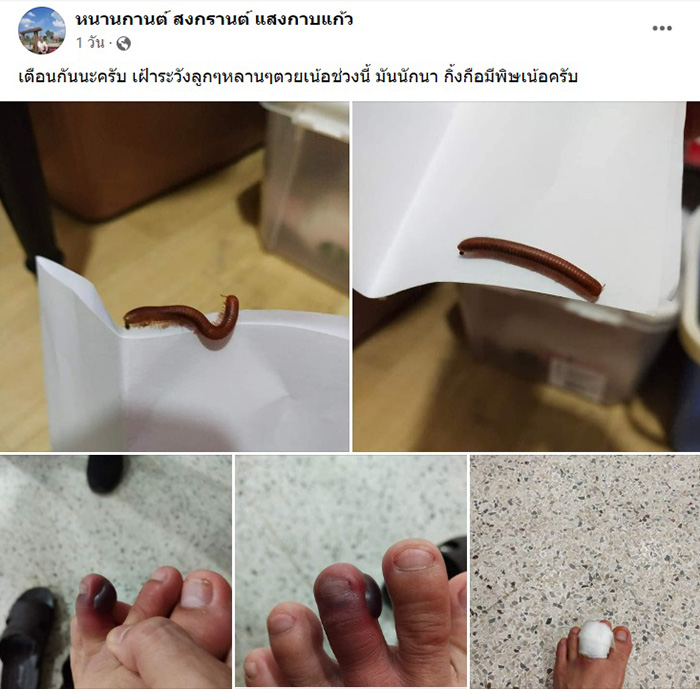 โดนพิษกิ้งกือที่นิ้วเท้า แผลใหญ่มาก น้องไม่กัด แต่พิษร้ายไม่เบา โดนพิษกิ้งกือที่นิ้วเท้า แผลใหญ่มาก น้องไม่กัด แต่พิษร้ายไม่เบา