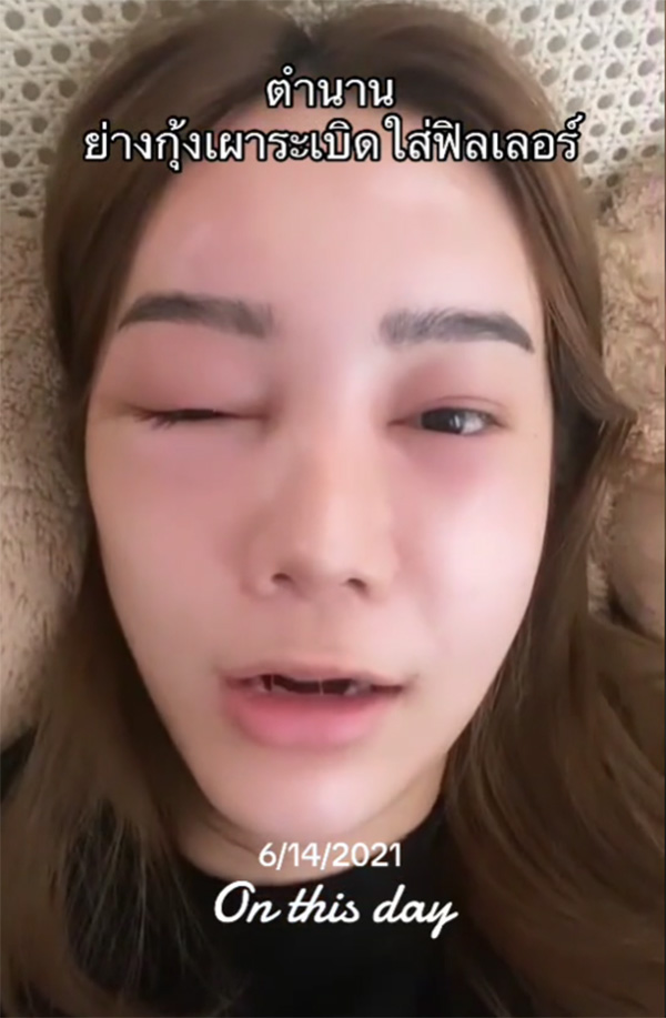 อุทาหรณ์ สาวฉีดฟิลเลอร์กินปิ้งย่าง กุ้งระเบิดใส่หน้าบวมเป่ง หวิดเสียโฉม อุทาหรณ์ สาวฉีดฟิลเลอร์กินปิ้งย่าง กุ้งระเบิดใส่หน้าบวมเป่ง หวิดเสียโฉม