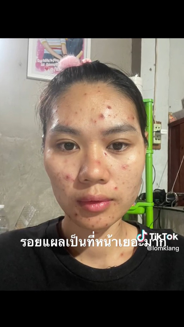 เจ้าสาวเป็นอีสุกอีใสก่อนแต่งงาน รอยแผลเป็นยับ เจอช่างแต่งหน้าเทพ เจ้าสาวเป็นอีสุกอีใสก่อนแต่งงาน รอยแผลเป็นยับ เจอช่างแต่งหน้าเทพ