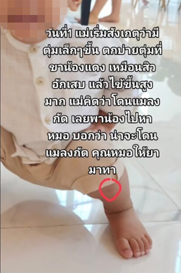 ลูกตุ่มแดงขึ้นนึกว่าแมลงกัด ก่อนทรุดส่งโรงพยาบาล ลูกตุ่มแดงขึ้นนึกว่าแมลงกัด ก่อนทรุดส่งโรงพยาบาล