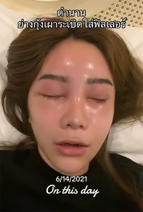 อุทาหรณ์ สาวฉีดฟิลเลอร์กินปิ้งย่าง กุ้งระเบิดใส่หน้าบวมเป่ง หวิดเสียโฉม อุทาหรณ์ สาวฉีดฟิลเลอร์กินปิ้งย่าง กุ้งระเบิดใส่หน้าบวมเป่ง หวิดเสียโฉม