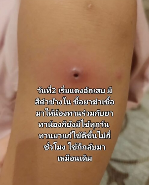 ลูกตุ่มแดงขึ้นนึกว่าแมลงกัด ก่อนทรุดส่งโรงพยาบาล ลูกตุ่มแดงขึ้นนึกว่าแมลงกัด ก่อนทรุดส่งโรงพยาบาล