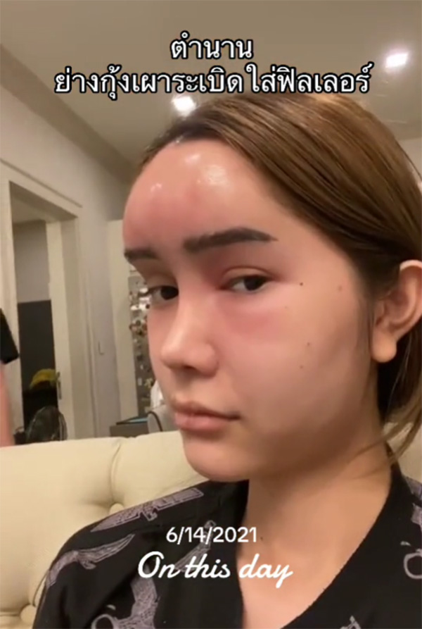 อุทาหรณ์ สาวฉีดฟิลเลอร์กินปิ้งย่าง กุ้งระเบิดใส่หน้าบวมเป่ง หวิดเสียโฉม อุทาหรณ์ สาวฉีดฟิลเลอร์กินปิ้งย่าง กุ้งระเบิดใส่หน้าบวมเป่ง หวิดเสียโฉม