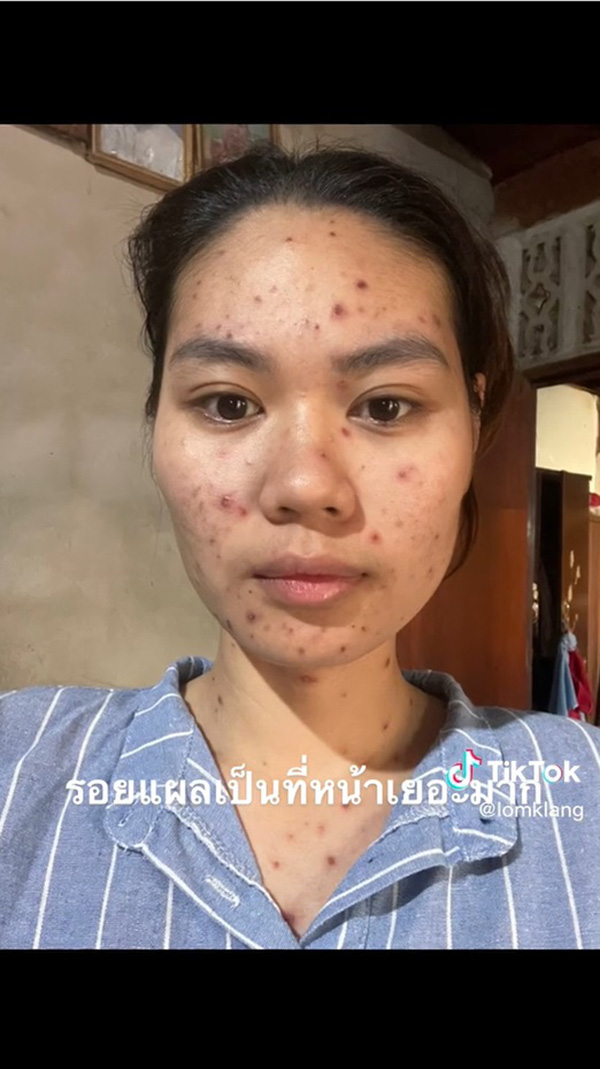 เจ้าสาวเป็นอีสุกอีใสก่อนแต่งงาน รอยแผลเป็นยับ เจอช่างแต่งหน้าเทพ เจ้าสาวเป็นอีสุกอีใสก่อนแต่งงาน รอยแผลเป็นยับ เจอช่างแต่งหน้าเทพ