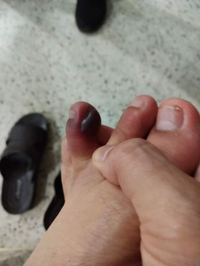 โดนพิษกิ้งกือที่นิ้วเท้า แผลใหญ่มาก น้องไม่กัด แต่พิษร้ายไม่เบา โดนพิษกิ้งกือที่นิ้วเท้า แผลใหญ่มาก น้องไม่กัด แต่พิษร้ายไม่เบา