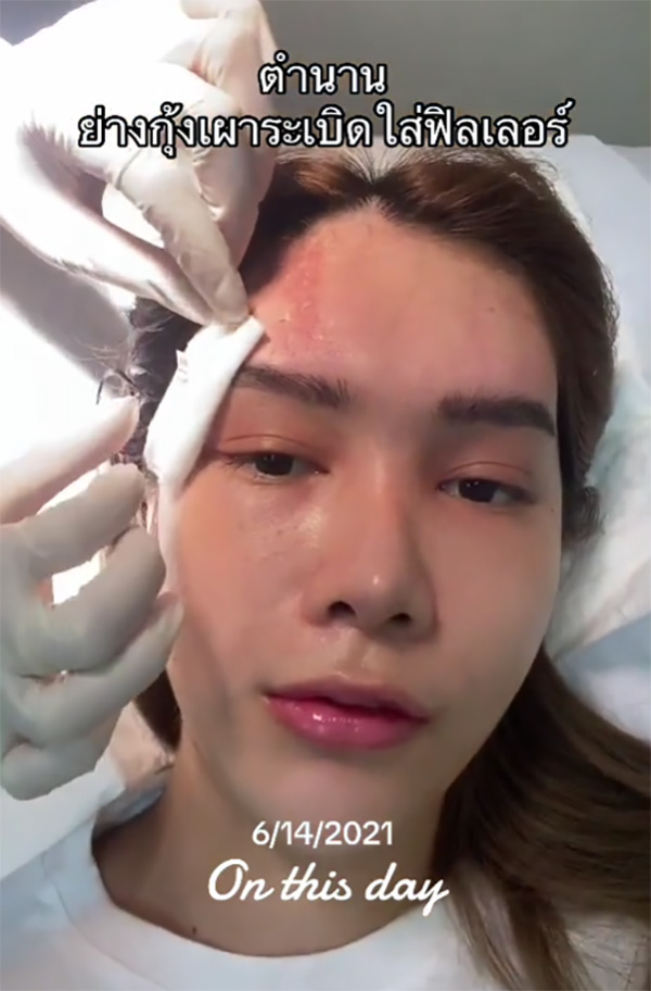 อุทาหรณ์ สาวฉีดฟิลเลอร์กินปิ้งย่าง กุ้งระเบิดใส่หน้าบวมเป่ง หวิดเสียโฉม อุทาหรณ์ สาวฉีดฟิลเลอร์กินปิ้งย่าง กุ้งระเบิดใส่หน้าบวมเป่ง หวิดเสียโฉม