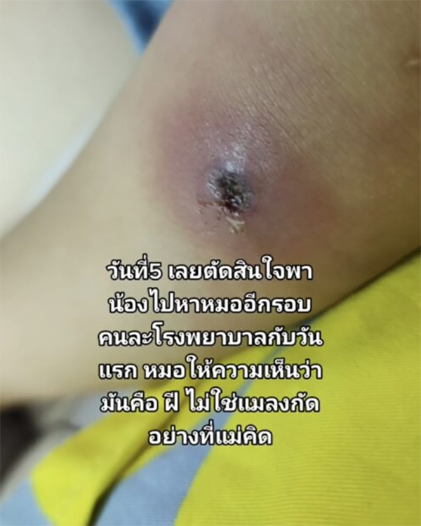 ลูกตุ่มแดงขึ้นนึกว่าแมลงกัด ก่อนทรุดส่งโรงพยาบาล ลูกตุ่มแดงขึ้นนึกว่าแมลงกัด ก่อนทรุดส่งโรงพยาบาล