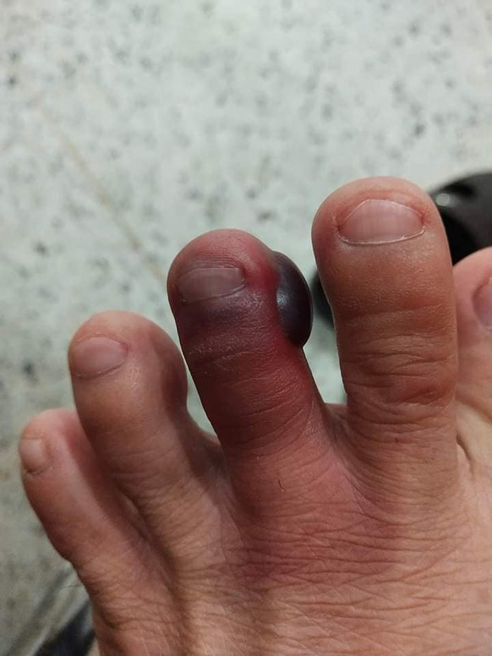 โดนพิษกิ้งกือที่นิ้วเท้า แผลใหญ่มาก น้องไม่กัด แต่พิษร้ายไม่เบา โดนพิษกิ้งกือที่นิ้วเท้า แผลใหญ่มาก น้องไม่กัด แต่พิษร้ายไม่เบา