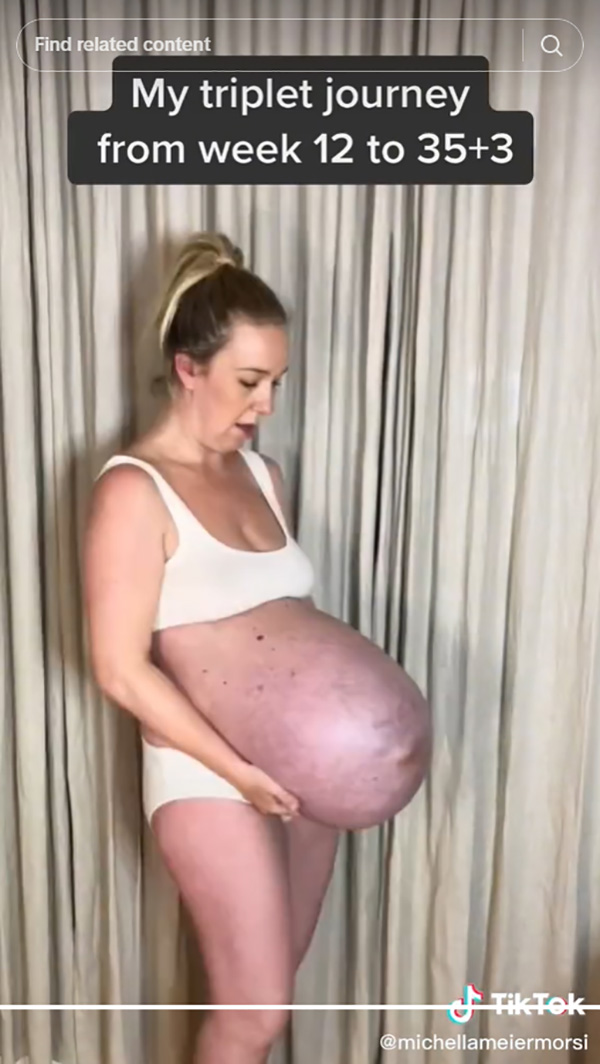 คุณแม่แฝดสาม อวดหน้าท้องตอปิโด ใหญ่โตแปลกตา จนเป็นไวรัล 137 ล้านวิว คุณแม่แฝดสาม อวดหน้าท้องตอปิโด ใหญ่โตแปลกตา จนเป็นไวรัล 137 ล้านวิว