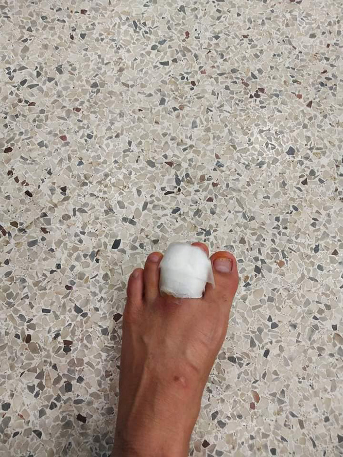 โดนพิษกิ้งกือที่นิ้วเท้า แผลใหญ่มาก น้องไม่กัด แต่พิษร้ายไม่เบา โดนพิษกิ้งกือที่นิ้วเท้า แผลใหญ่มาก น้องไม่กัด แต่พิษร้ายไม่เบา