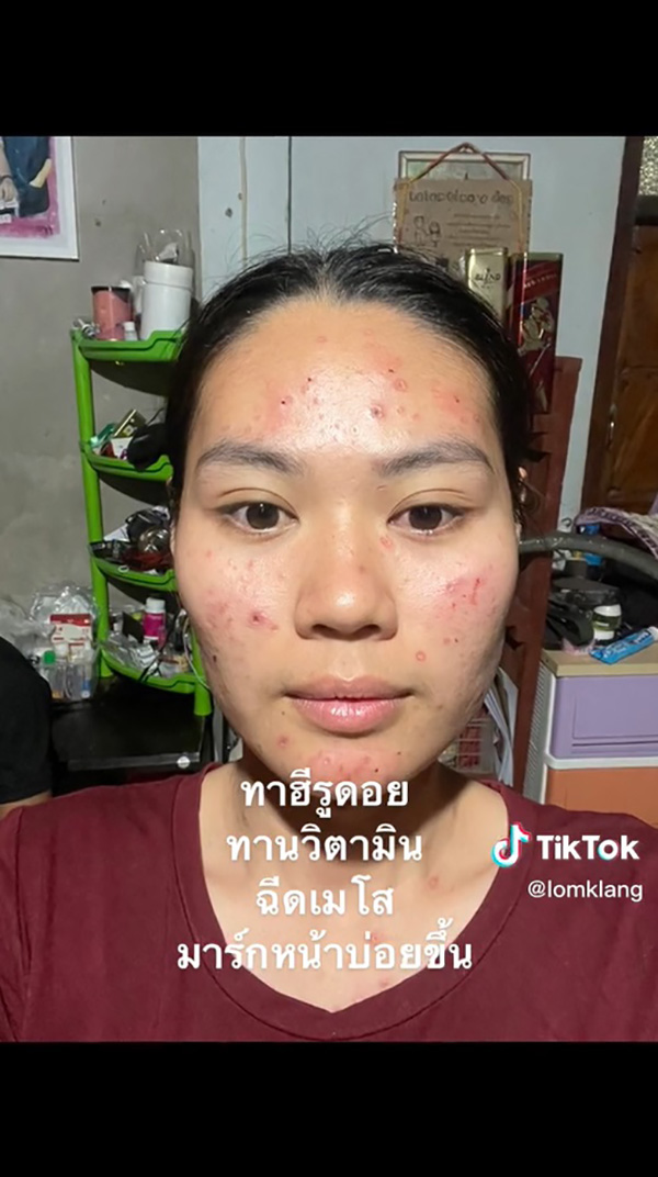 เจ้าสาวเป็นอีสุกอีใสก่อนแต่งงาน รอยแผลเป็นยับ เจอช่างแต่งหน้าเทพ เจ้าสาวเป็นอีสุกอีใสก่อนแต่งงาน รอยแผลเป็นยับ เจอช่างแต่งหน้าเทพ