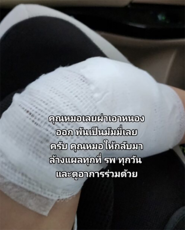 ลูกตุ่มแดงขึ้นนึกว่าแมลงกัด ก่อนทรุดส่งโรงพยาบาล ลูกตุ่มแดงขึ้นนึกว่าแมลงกัด ก่อนทรุดส่งโรงพยาบาล