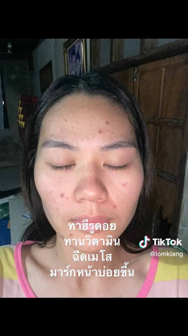 เจ้าสาวเป็นอีสุกอีใสก่อนแต่งงาน รอยแผลเป็นยับ เจอช่างแต่งหน้าเทพ เจ้าสาวเป็นอีสุกอีใสก่อนแต่งงาน รอยแผลเป็นยับ เจอช่างแต่งหน้าเทพ