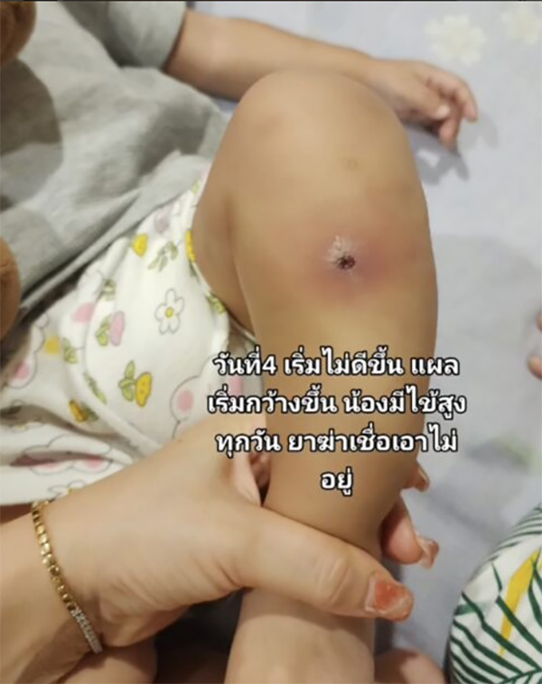 ลูกตุ่มแดงขึ้นนึกว่าแมลงกัด ก่อนทรุดส่งโรงพยาบาล ลูกตุ่มแดงขึ้นนึกว่าแมลงกัด ก่อนทรุดส่งโรงพยาบาล