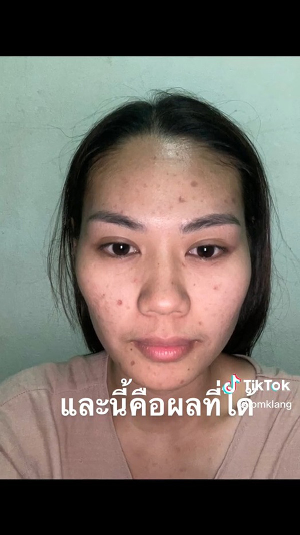 เจ้าสาวเป็นอีสุกอีใสก่อนแต่งงาน รอยแผลเป็นยับ เจอช่างแต่งหน้าเทพ เจ้าสาวเป็นอีสุกอีใสก่อนแต่งงาน รอยแผลเป็นยับ เจอช่างแต่งหน้าเทพ