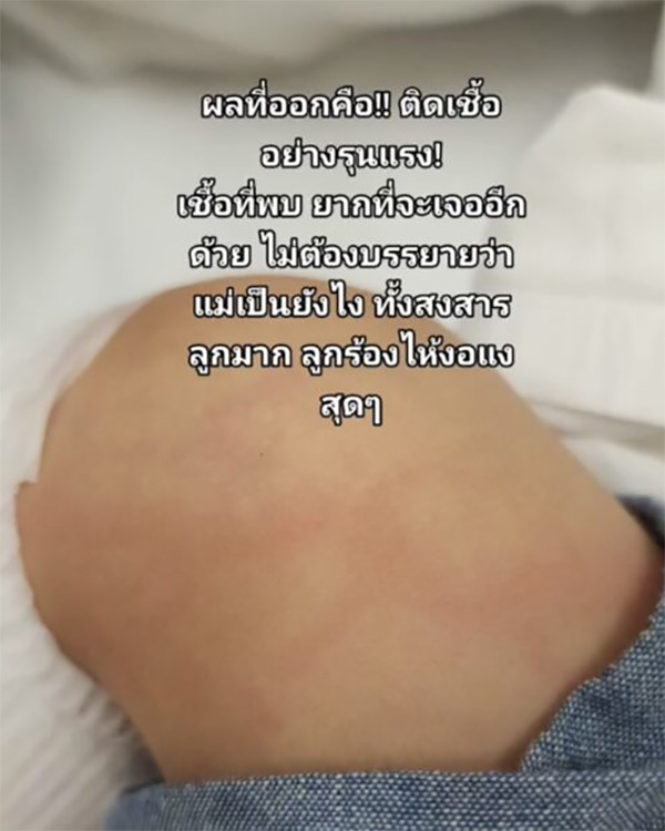 ลูกตุ่มแดงขึ้นนึกว่าแมลงกัด ก่อนทรุดส่งโรงพยาบาล ลูกตุ่มแดงขึ้นนึกว่าแมลงกัด ก่อนทรุดส่งโรงพยาบาล
