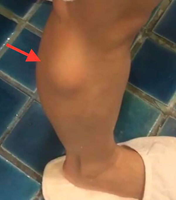 ก้อนเนื้อผิดปกติ ก้อนเนื้อผิดปกติ