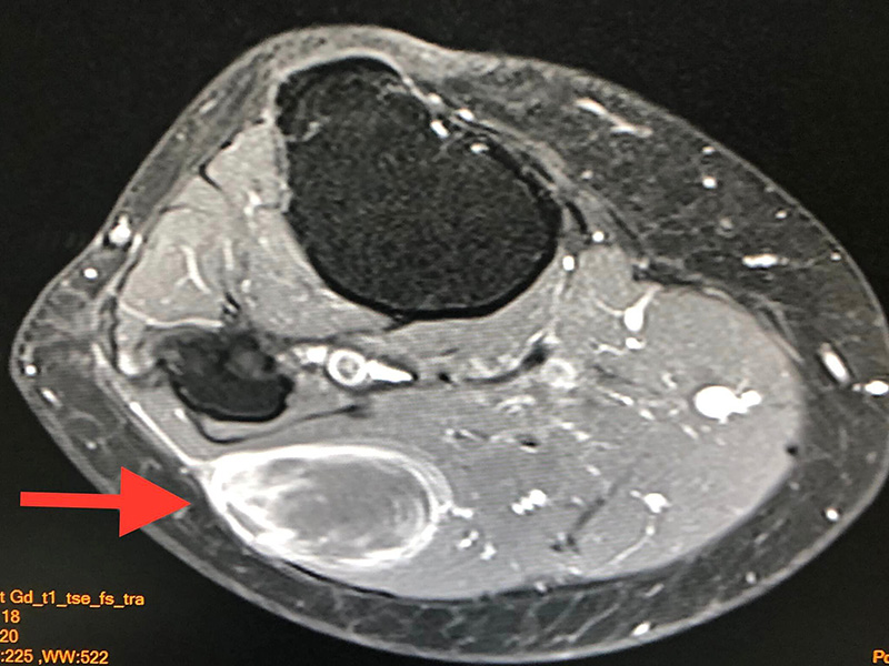 ก้อนเนื้อผิดปกติ ก้อนเนื้อผิดปกติ