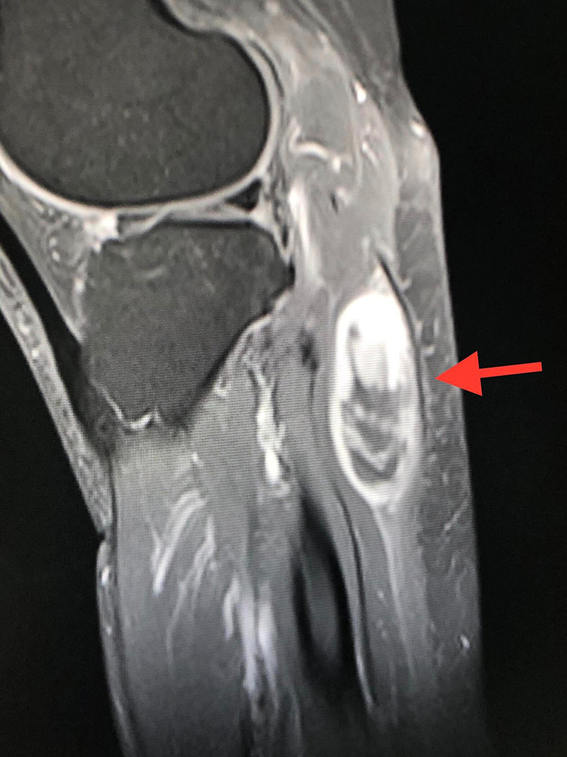ก้อนเนื้อผิดปกติ ก้อนเนื้อผิดปกติ