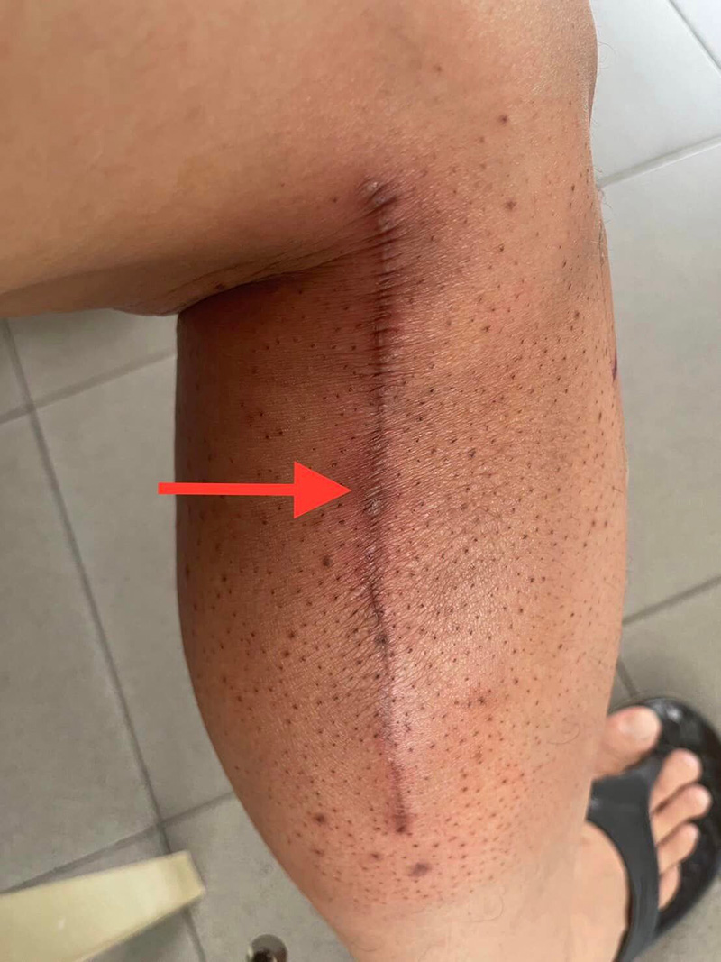 ก้อนเนื้อผิดปกติ ก้อนเนื้อผิดปกติ