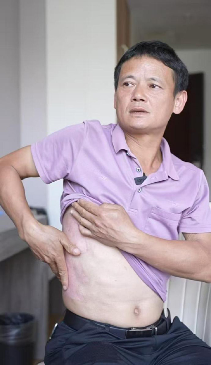 หนุ่มหล่อหวิดดับ เหตุแบต จักรยานไฟฟ้าระเบิด หนุ่มหล่อหวิดดับ เหตุแบต จักรยานไฟฟ้าระเบิด