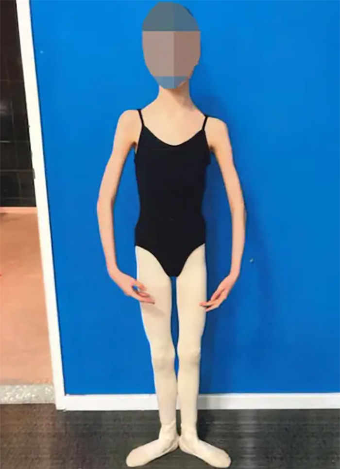 พ่อแม่เจอคุก อดอาหารลูกจนหนัก 27 กก พ่อแม่เจอคุก อดอาหารลูกจนหนัก 27 กก