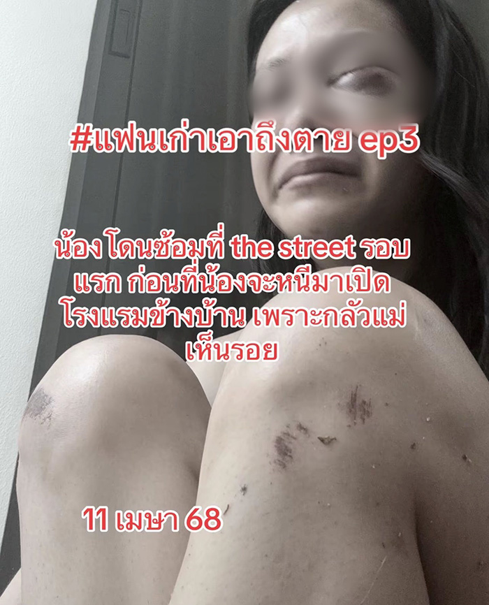 นางเอกเอ็มวีดัง โดนแฟนเก่าตีหัวเลือดอาบ นางเอกเอ็มวีดัง โดนแฟนเก่าตีหัวเลือดอาบ