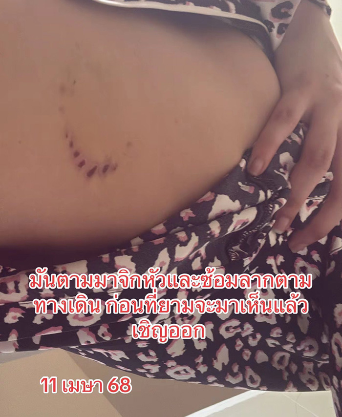 นางเอกเอ็มวีดัง โดนแฟนเก่าตีหัวเลือดอาบ นางเอกเอ็มวีดัง โดนแฟนเก่าตีหัวเลือดอาบ