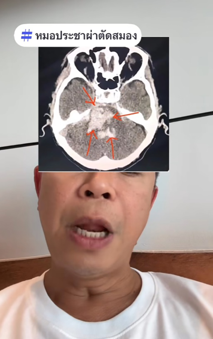 หนุ่มวัย 29 เพิ่งแต่งงาน เป็นอัมพาต เมียดูแล 2 ปี หนุ่มวัย 29 เพิ่งแต่งงาน เป็นอัมพาต เมียดูแล 2 ปี