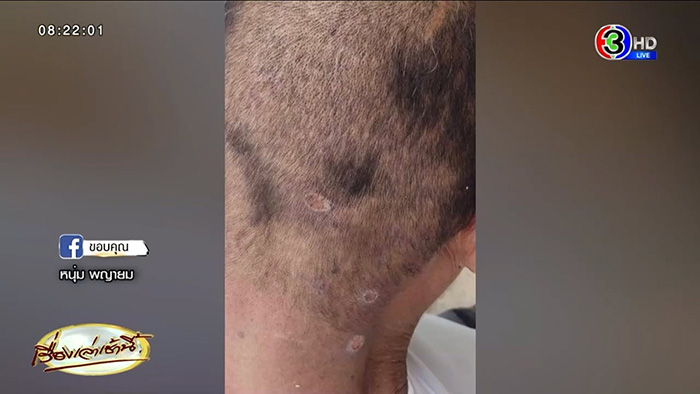 ชายหาหน่อไม้ในป่า กลับมาป่วยประหลาด ชายหาหน่อไม้ในป่า กลับมาป่วยประหลาด