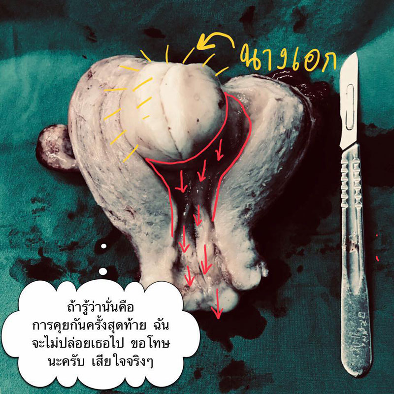 สาวกลัวตายไม่ผ่าเนื้องอก สาวกลัวตายไม่ผ่าเนื้องอก