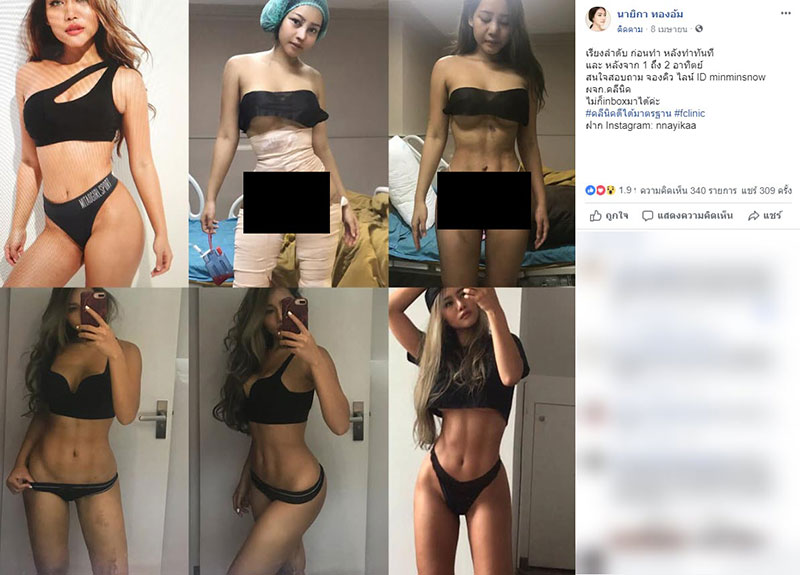 รีวิวศัลยกรรม 6 จุด รีวิวศัลยกรรม 6 จุด