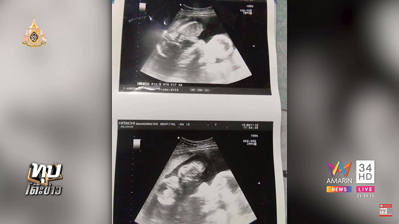 แม่ท้องแฝดเศร้า แม่ท้องแฝดเศร้า