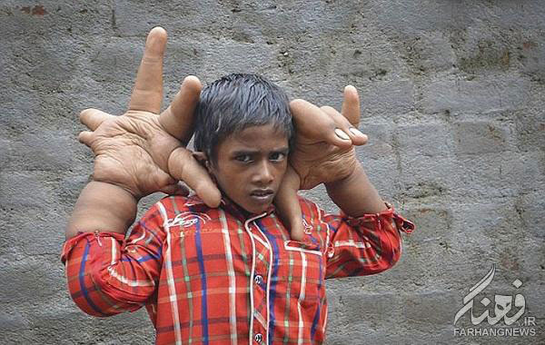 เด็กมือยักษ์ เด็กมือยักษ์