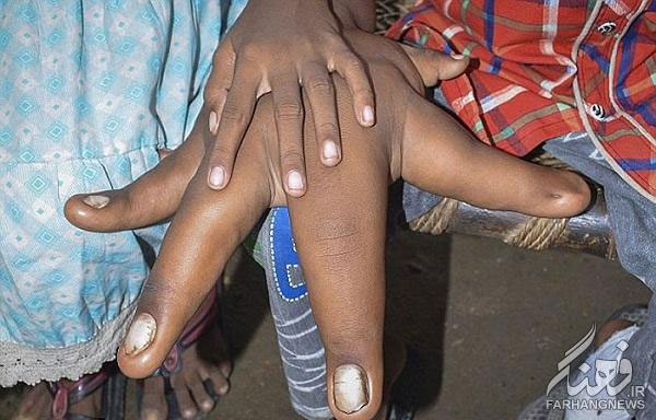 เด็กมือยักษ์ เด็กมือยักษ์