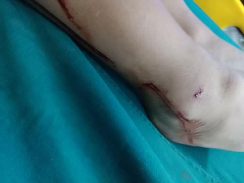 หมากัดเด็ก หมากัดเด็ก