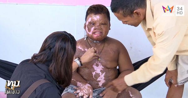 เด็กถูกไฟคลอก เด็กถูกไฟคลอก