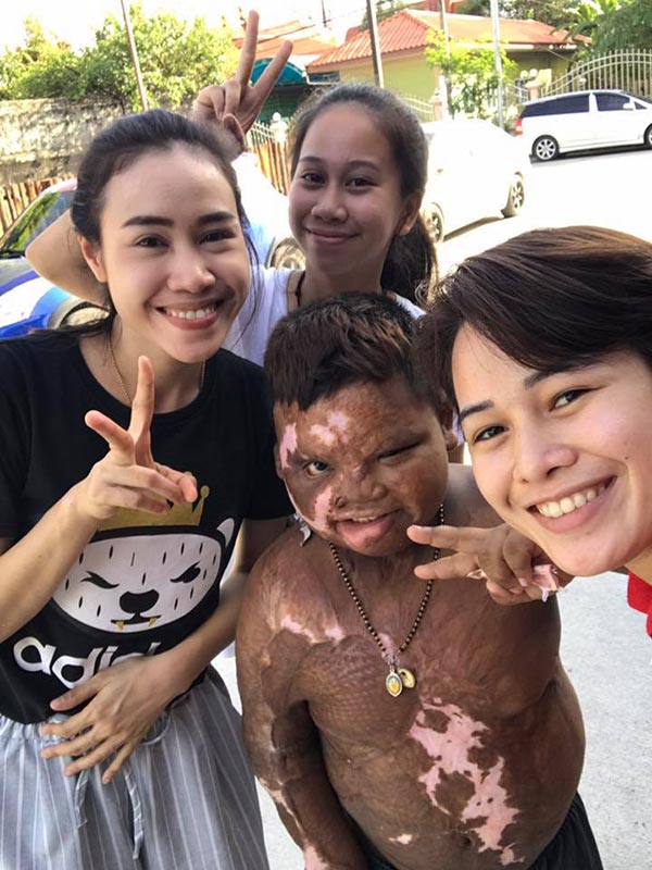 เด็กถูกไฟคลอก เด็กถูกไฟคลอก