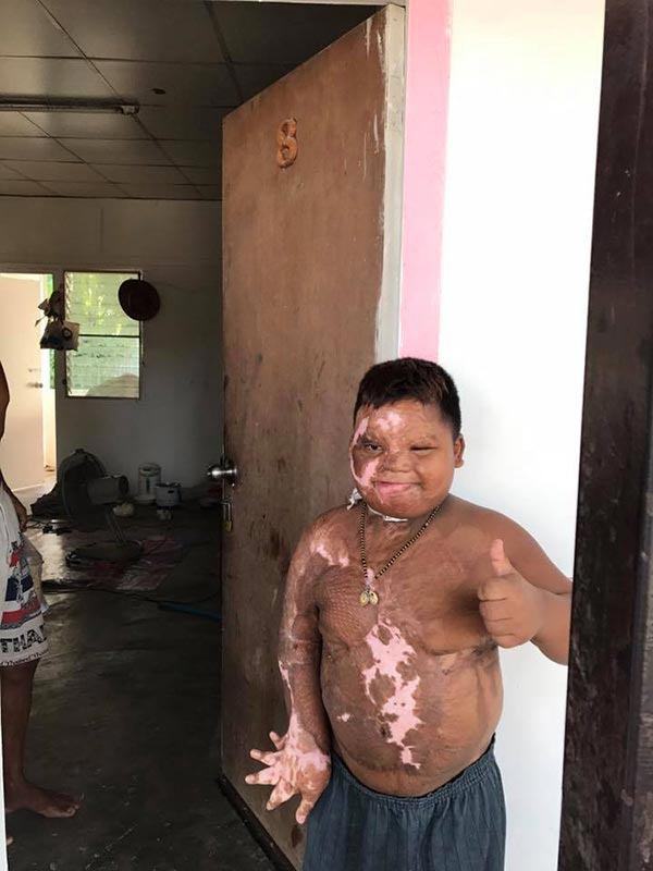 เด็กถูกไฟคลอก เด็กถูกไฟคลอก