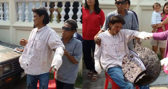 ถังน้ำมัน 200 ลิตร ระเบิด ฝาพุ่งตัดข้อมือหนุ่มโคราช เจ็บสาหัส ถังน้ำมัน 200 ลิตร ระเบิด ฝาพุ่งตัดข้อมือหนุ่มโคราช เจ็บสาหัส