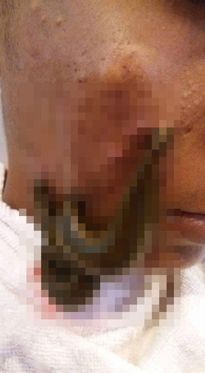 ปลิงดูดสิว เจอชาวเน็ตถาม ต้องเป็นสิวขนาดไหนถึงยอมให้ปลิงดูดหน้า ปลิงดูดสิว เจอชาวเน็ตถาม ต้องเป็นสิวขนาดไหนถึงยอมให้ปลิงดูดหน้า