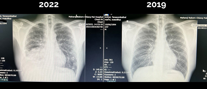 คาดสาเหตุที่หมอกฤตไท เป็นมะเร็งปอด ทั้งที่อายุ 28 ดูแลร่างกายอย่างดี ภัยใกล้ตัวกว่าที่คิด คาดสาเหตุที่หมอกฤตไท เป็นมะเร็งปอด ทั้งที่อายุ 28 ดูแลร่างกายอย่างดี ภัยใกล้ตัวกว่าที่คิด