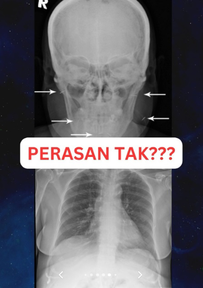 หญิงป่วยเข้า รพ. แพทย์หลอนเจอเข็มเสน่ห์ฝังทั่ว ขอให้เอาออกก็ไม่ยอม ก่อนสิ้นลม หญิงป่วยเข้า รพ. แพทย์หลอนเจอเข็มเสน่ห์ฝังทั่ว ขอให้เอาออกก็ไม่ยอม ก่อนสิ้นลม