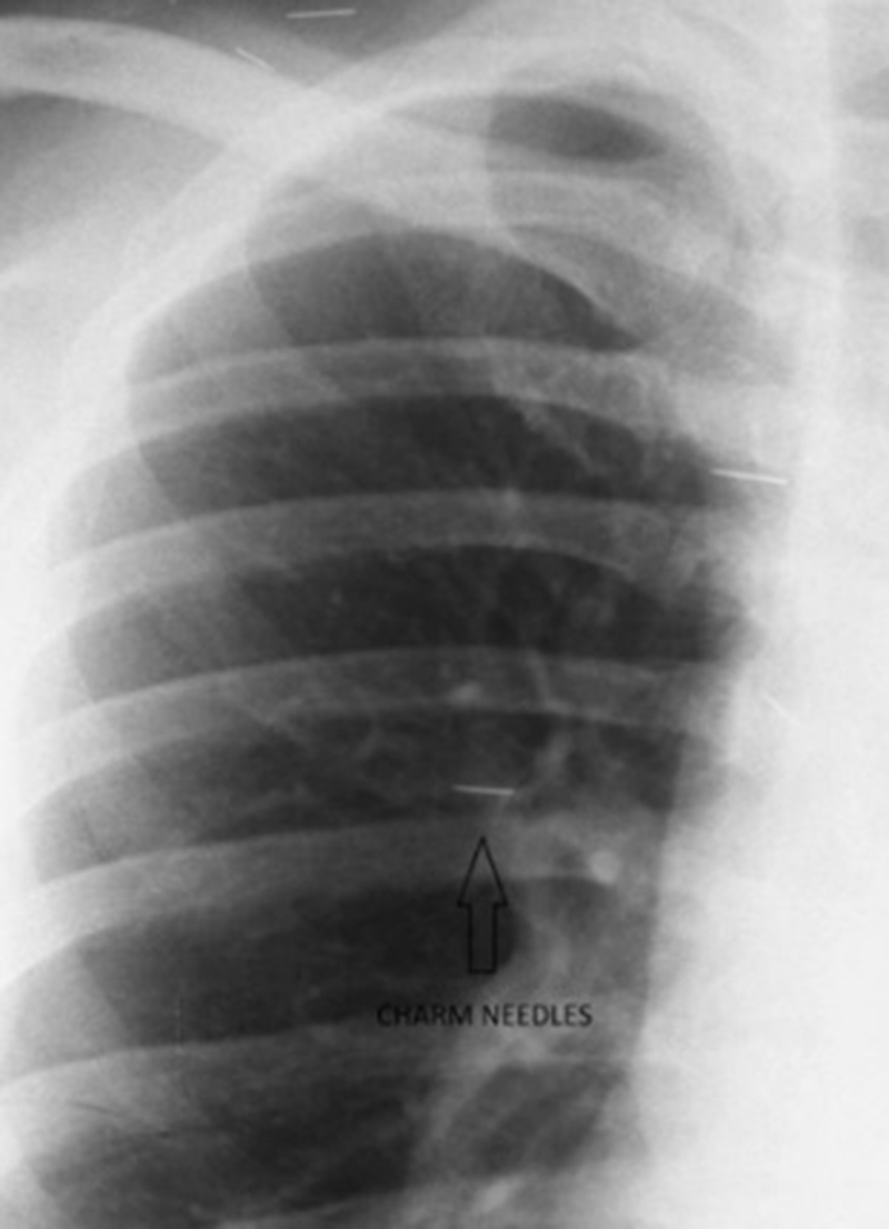 หญิงป่วยเข้า รพ. แพทย์หลอนเจอเข็มเสน่ห์ฝังทั่ว ขอให้เอาออกก็ไม่ยอม ก่อนสิ้นลม หญิงป่วยเข้า รพ. แพทย์หลอนเจอเข็มเสน่ห์ฝังทั่ว ขอให้เอาออกก็ไม่ยอม ก่อนสิ้นลม