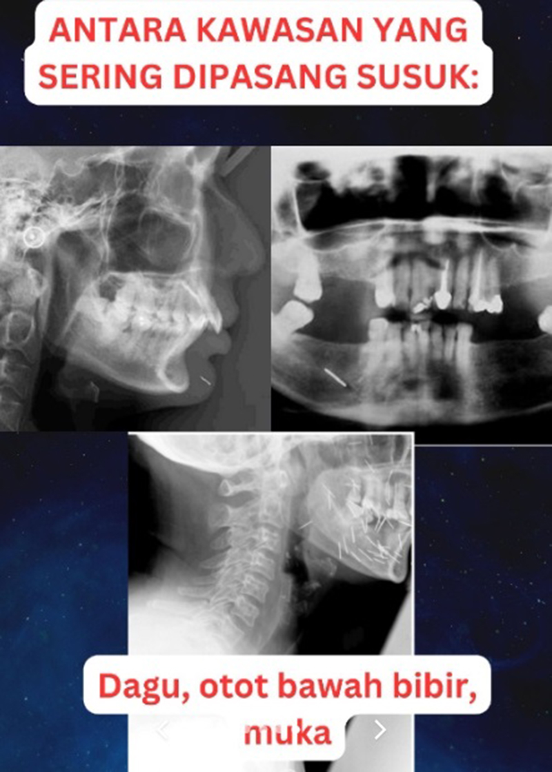 หญิงป่วยเข้า รพ. แพทย์หลอนเจอเข็มเสน่ห์ฝังทั่ว ขอให้เอาออกก็ไม่ยอม ก่อนสิ้นลม หญิงป่วยเข้า รพ. แพทย์หลอนเจอเข็มเสน่ห์ฝังทั่ว ขอให้เอาออกก็ไม่ยอม ก่อนสิ้นลม