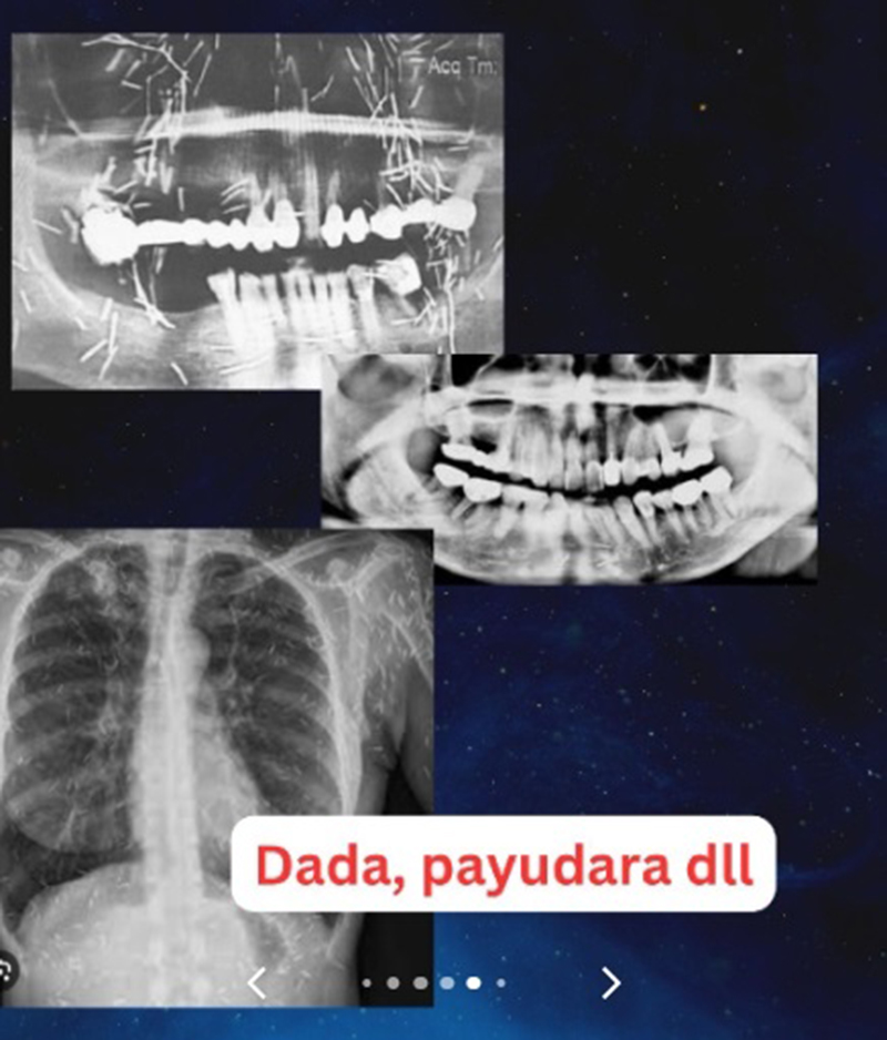 หญิงป่วยเข้า รพ. แพทย์หลอนเจอเข็มเสน่ห์ฝังทั่ว ขอให้เอาออกก็ไม่ยอม ก่อนสิ้นลม หญิงป่วยเข้า รพ. แพทย์หลอนเจอเข็มเสน่ห์ฝังทั่ว ขอให้เอาออกก็ไม่ยอม ก่อนสิ้นลม